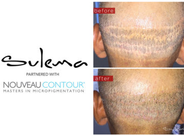 Sulema Permanent Makeup Portfolio - Scalp Micropigmentation Scar