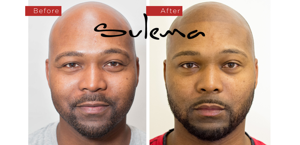 Sulema Permanent Makeup Studio - Scalp Micropigmentation